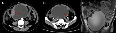Case report: Giant cystic ileal gastrointestinal stromal tumor with an atypical intratumoral abscess